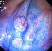 Argon-Plasma-Koagulation